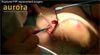 Ruptured PIP Implant
