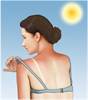 Melanoma on the rise among young women