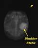 Pic 1 - Humphrey s X-ray showing the stone