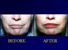 Before-and-After Perioral Rejuvenation