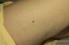 melanoma