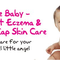 cradle cap and infant eczema