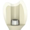 Atlantis™ crown abutment