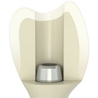 Atlantis™ crown abutment