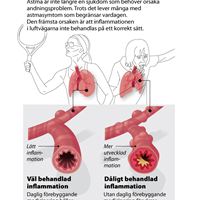 Astma beror på en inflammation i luftrören