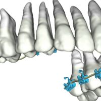  Model of SureSmile Lingual Braces