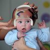 Plagiocephaly