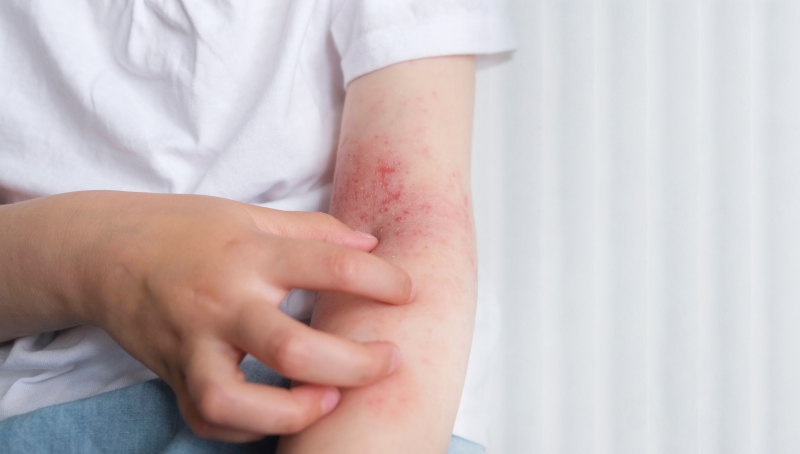 pharmability-CTA-TIR-C-first-in-human-study-atopic-dermatitis.png