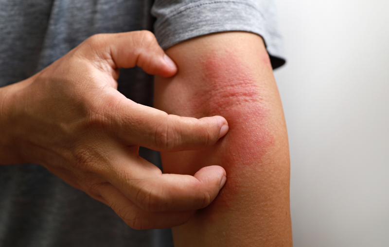 Pharmability-first-patient-dosed-phase-Ib-atopic-dermatitis.png