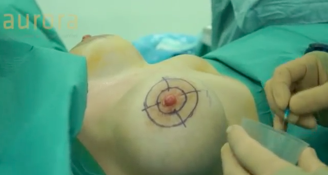 Areola Reduction Surgery From 7 5cm To 4cm Aurora Clinics